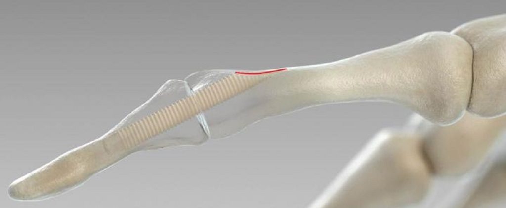 surgical screw made of bone by © surgebright 1024 surgical screw made of bone by © surgebright