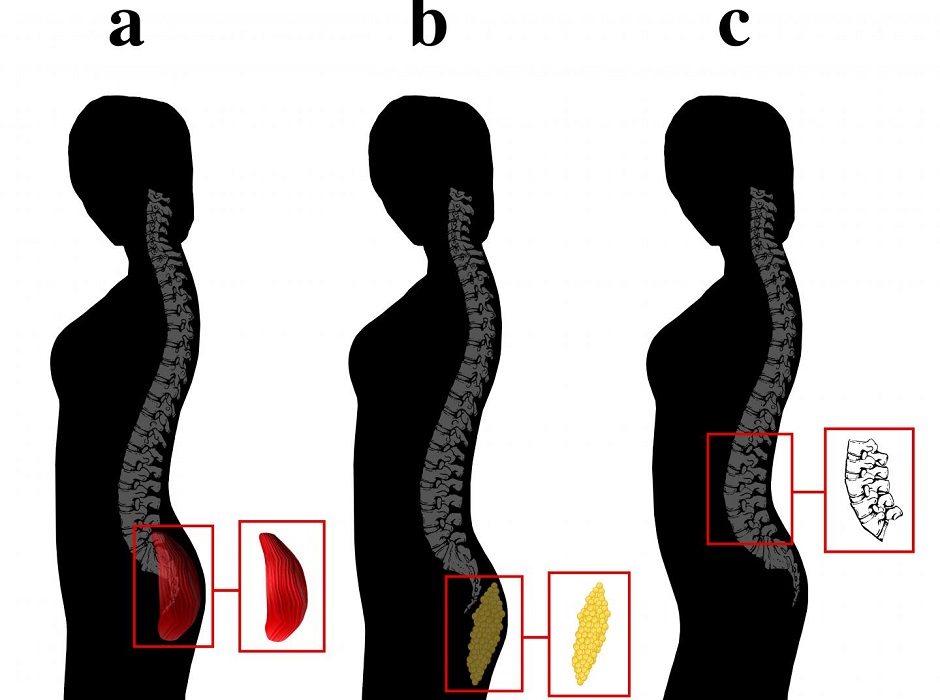 All about that Vertebral Wedging Trebuchet Magazine